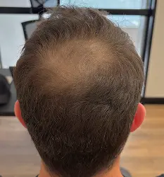 Afinamento na coroa antes